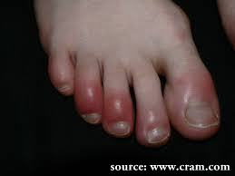 chilblain feet