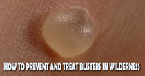 How To Prevent And Treat Blisters In Wilderness
