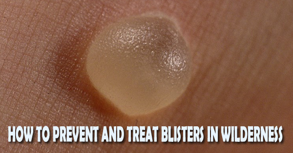 prevent blisters on a trek