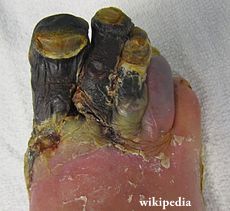 gangrene feet
